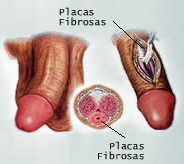 Doença Peyrone | Clínica de Andrologia e Urologia